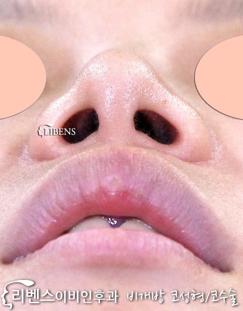 들창코 매부리코 콧대 코끝 성형 수술 교정 실리콘 2미리 성형 s536